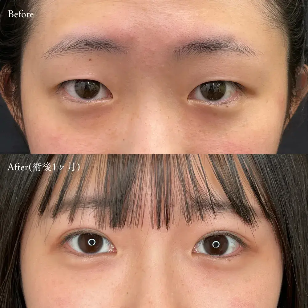 二重埋没法の症例写真(女性 術前・術後1ヶ月)