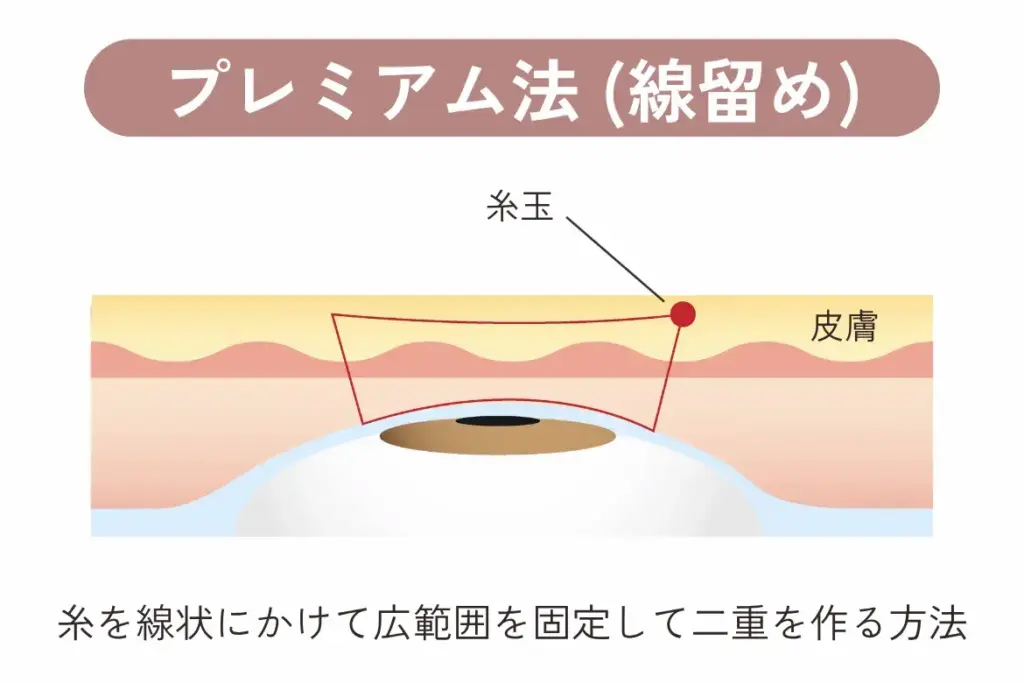 二重埋没 プレミアム法