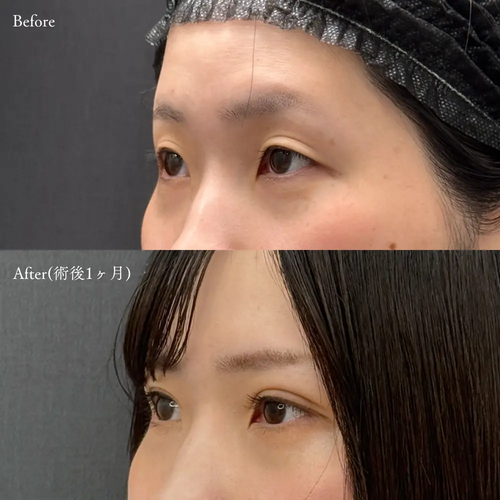 二重埋没法の症例