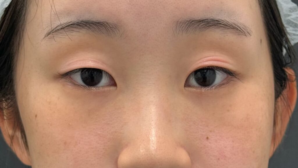 アイプチ・テープの長期使用で荒れた瞼