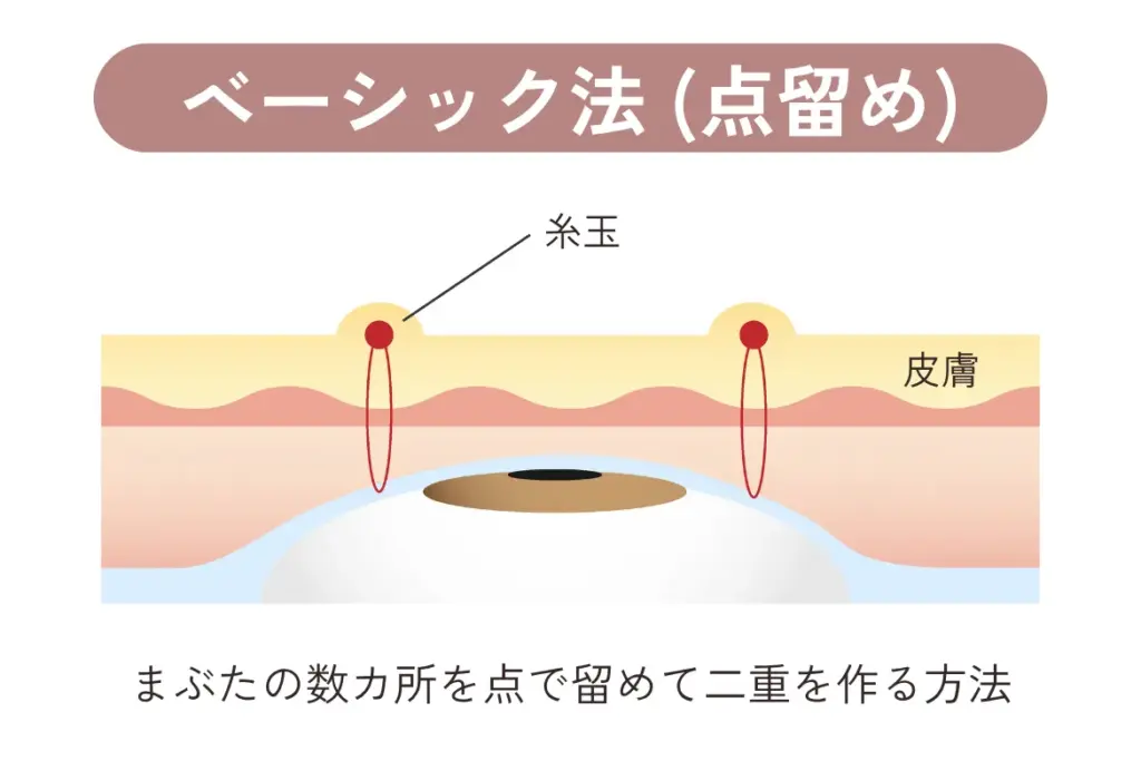 ベーシック法(点留め)