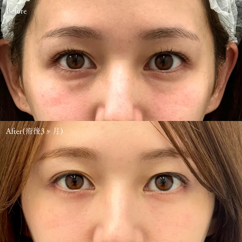 裏ハムラ法 症例写真