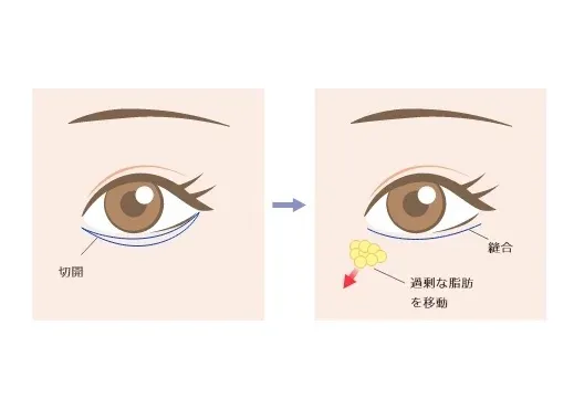 切開ハムラ法