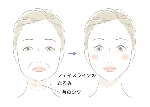 ボトックスリフト