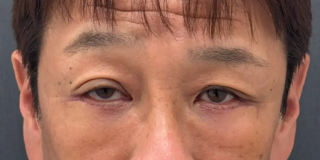 術後1週間