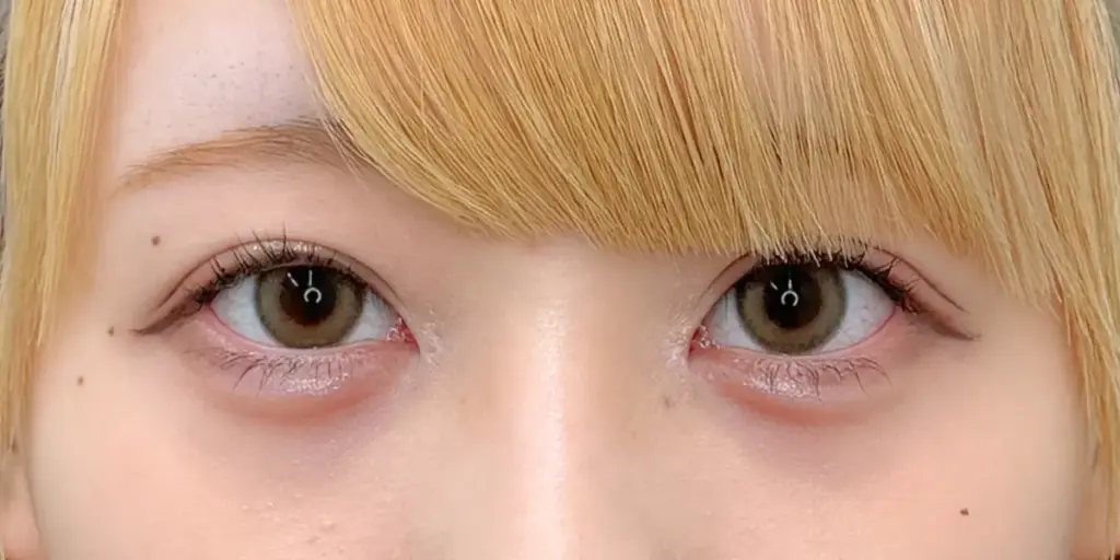目頭切開の術後1ヶ月