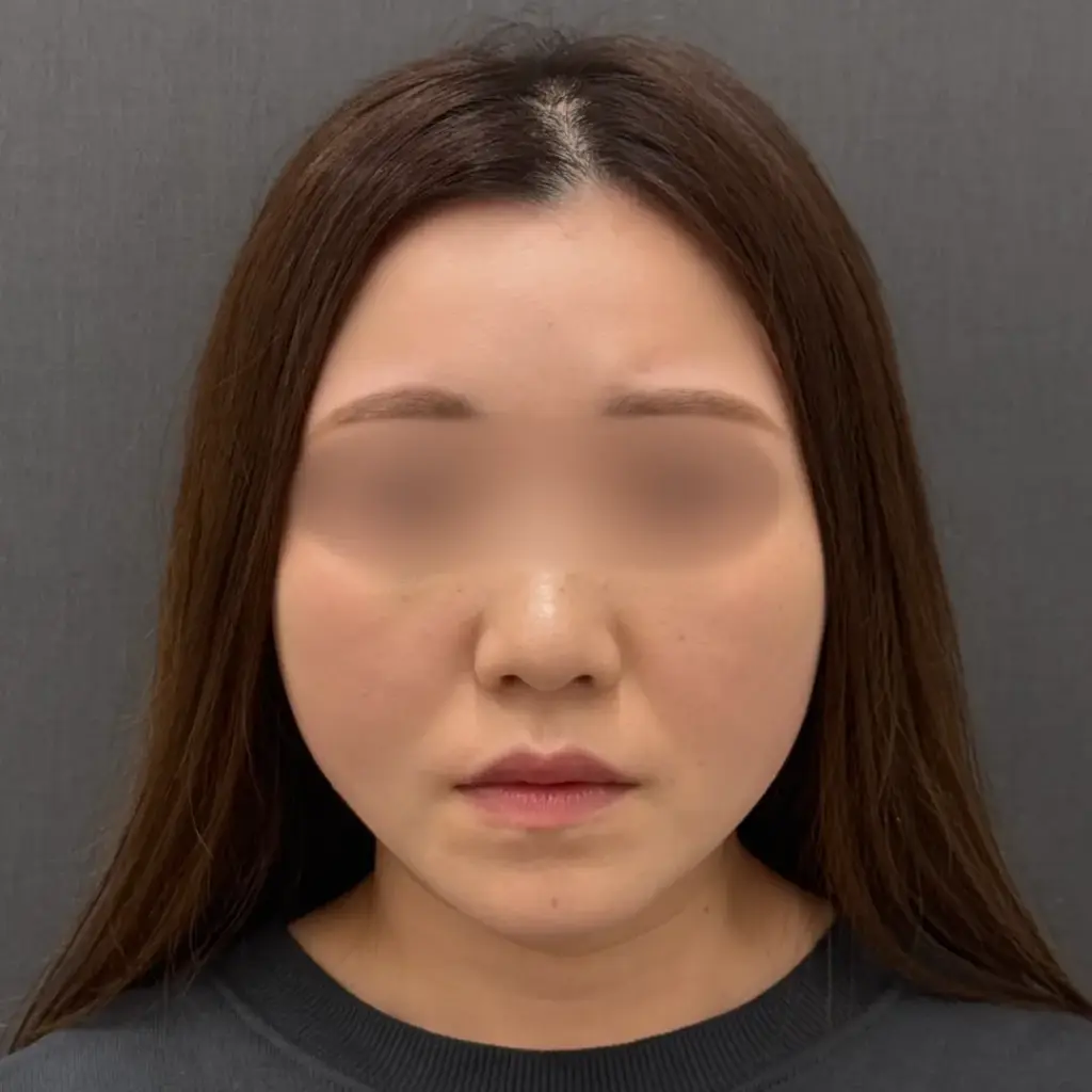 糸リフト術後1週間の様子