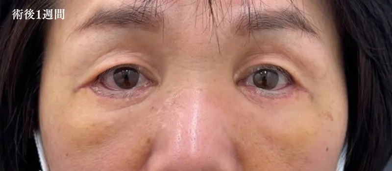 切開ハムラ法の経過(術後1週間)