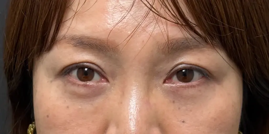 経結膜脱脂術のダウンタイム