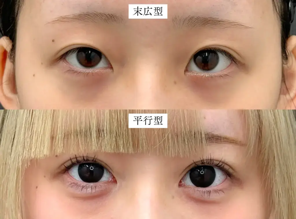 末広型と平行型の比較