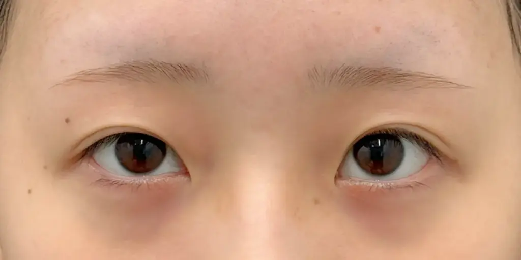 目頭切開の術前
