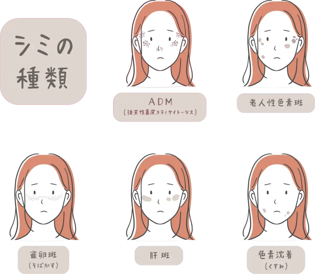 シミの種類