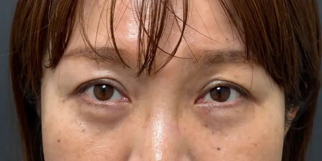 経結膜脱脂術のダウンタイム