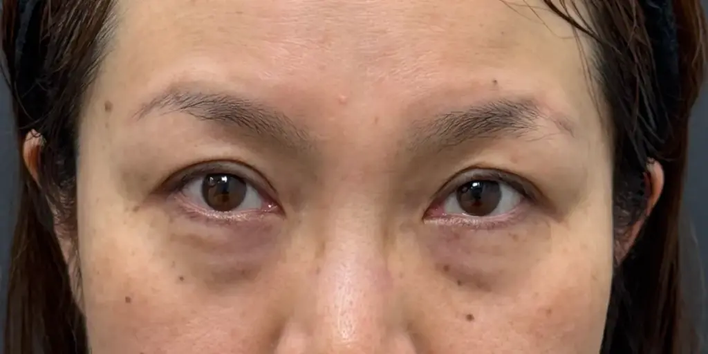 経結膜脱脂術のダウンタイム