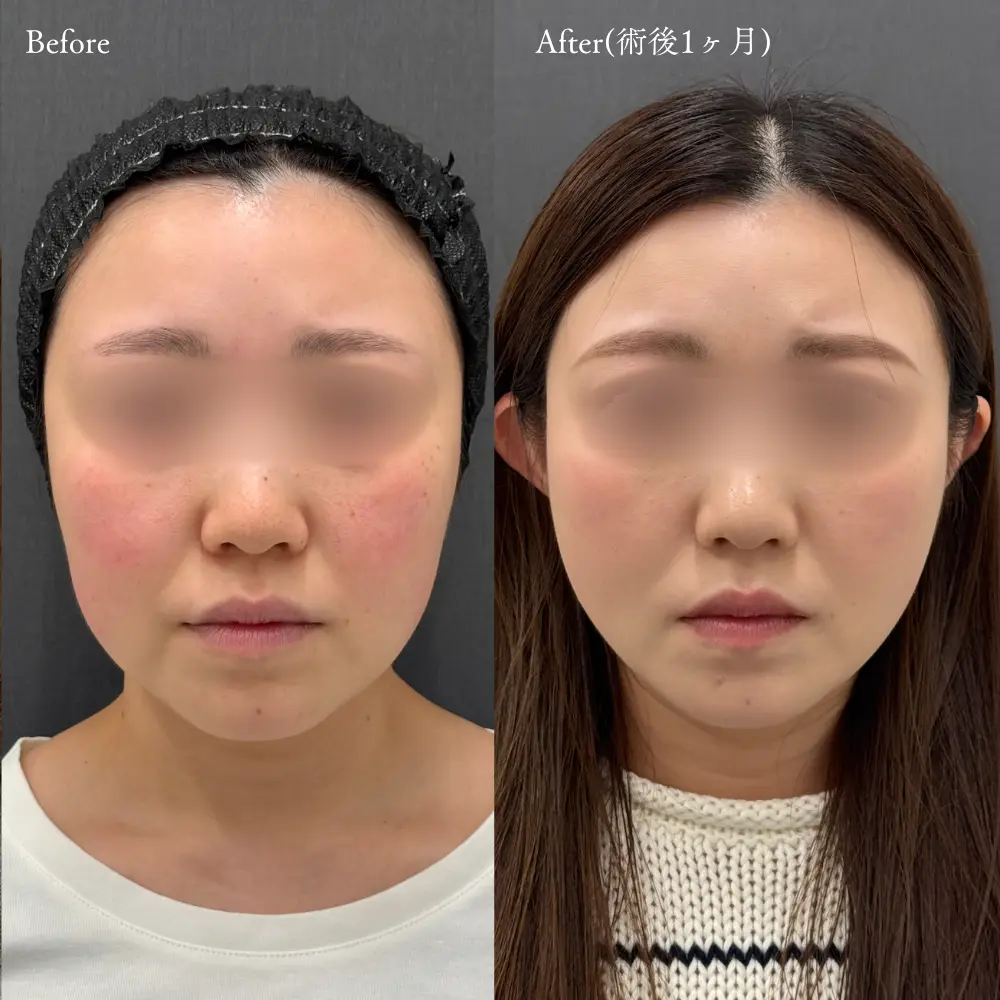 糸リフト症例