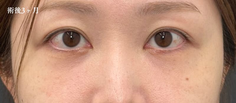 裏ハムラ法の経過(術後3ヶ月)