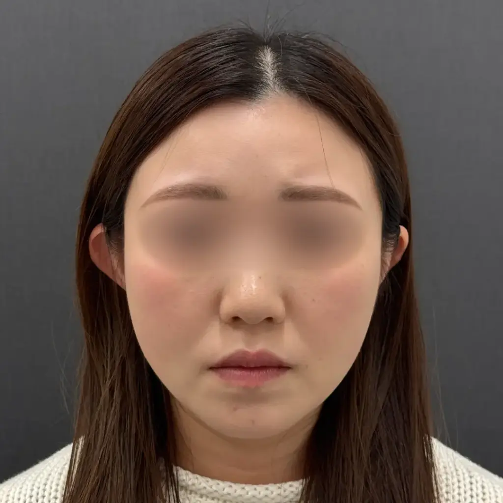 糸リフト術後1ヶ月の様子