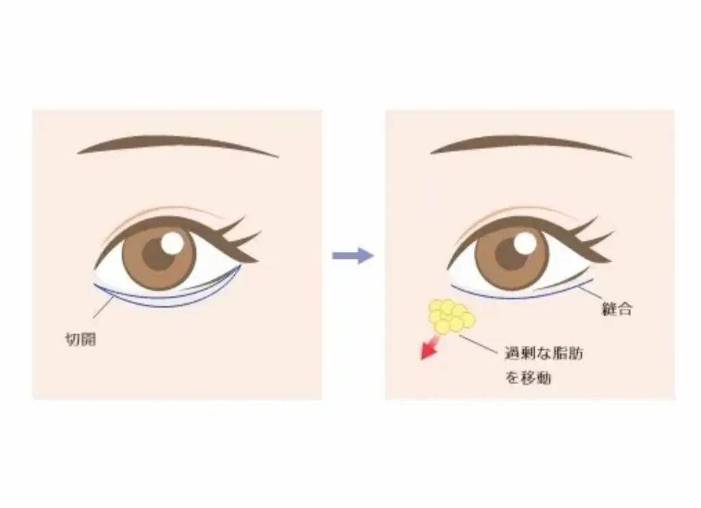 切開ハムラ(表ハムラ)法とは