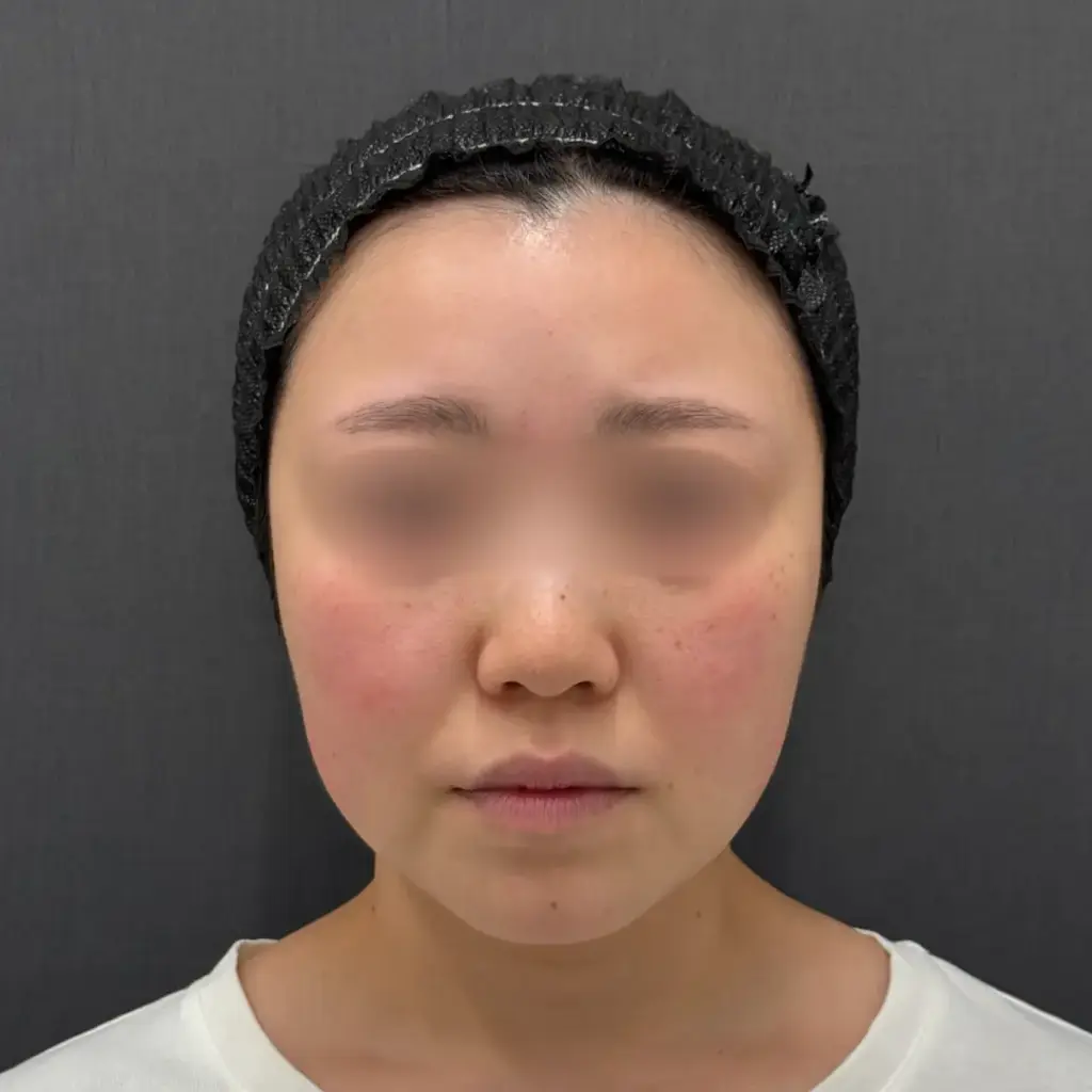 糸リフト術前の様子