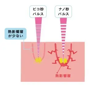 ピコレーザー(シミ取りレーザー)とは