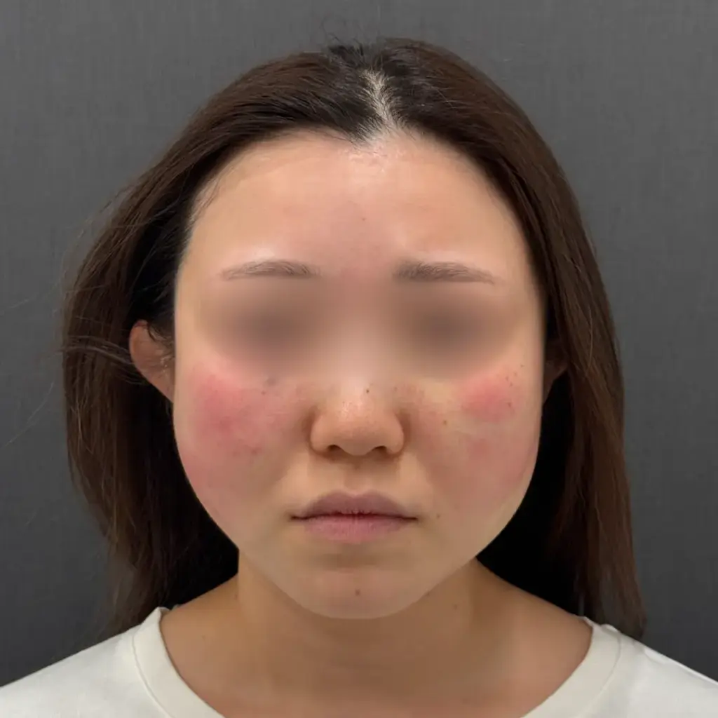 糸リフト術直後の様子