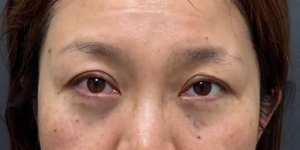 経結膜脱脂術のダウンタイム