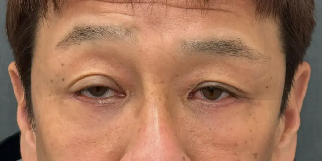 術後1ヶ月