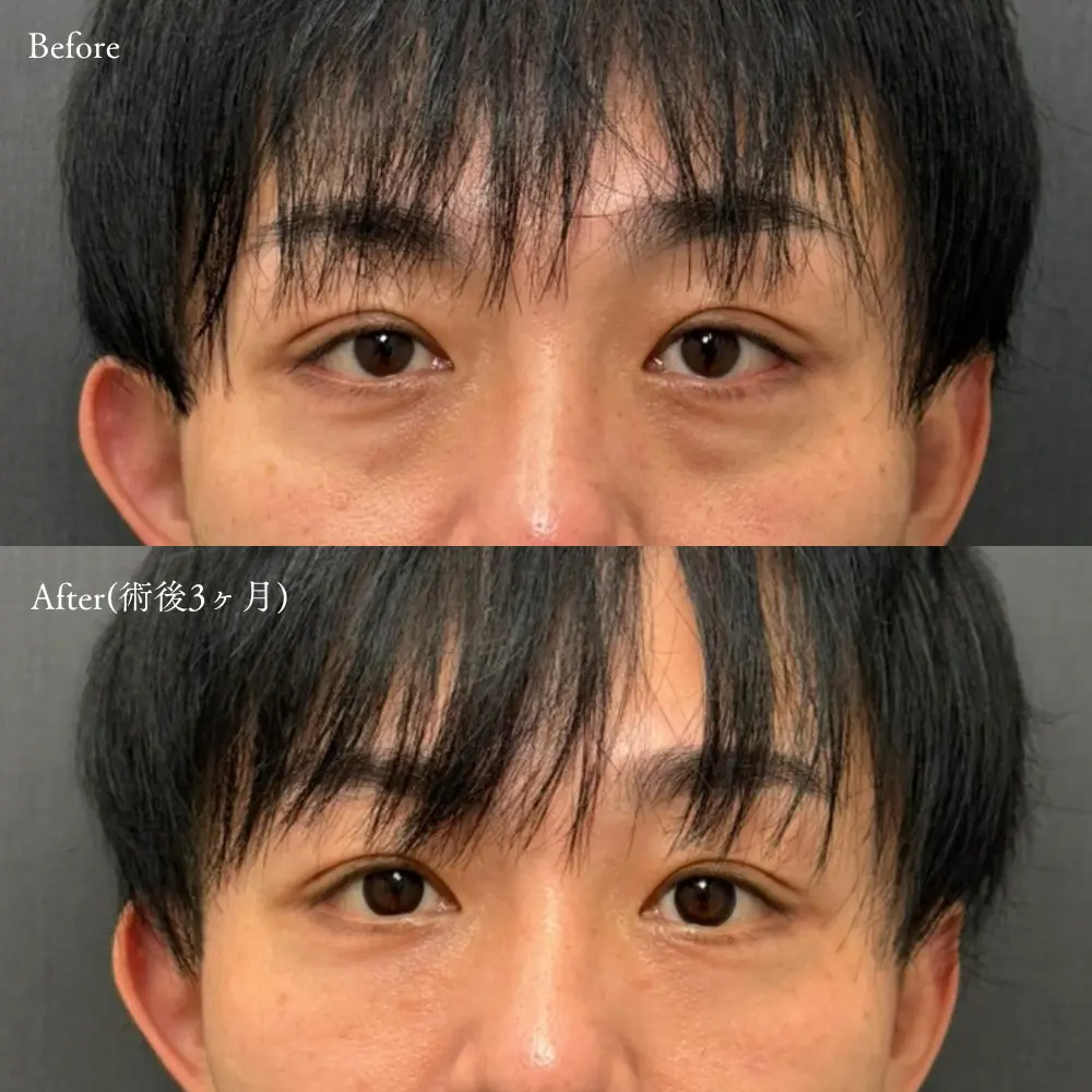 裏ハムラ法の症例