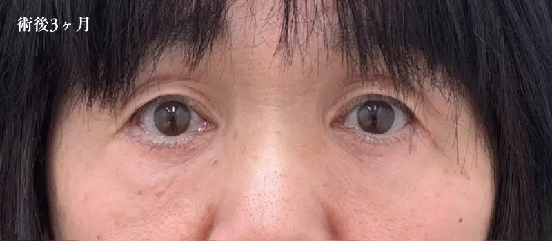 切開ハムラ法の経過(術後3ヶ月)