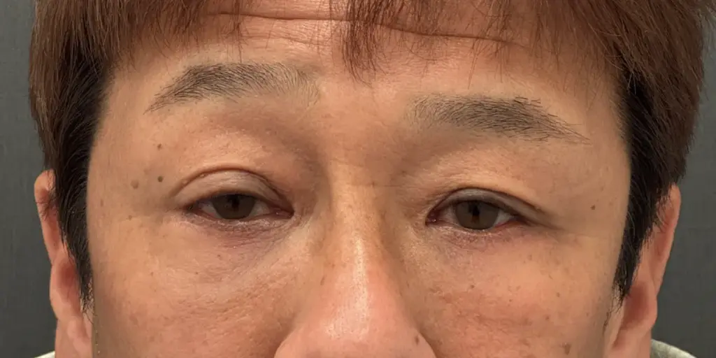 術後3ヶ月