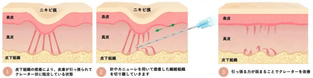 サブシジョン(ニキビ跡・クレーター治療)とは