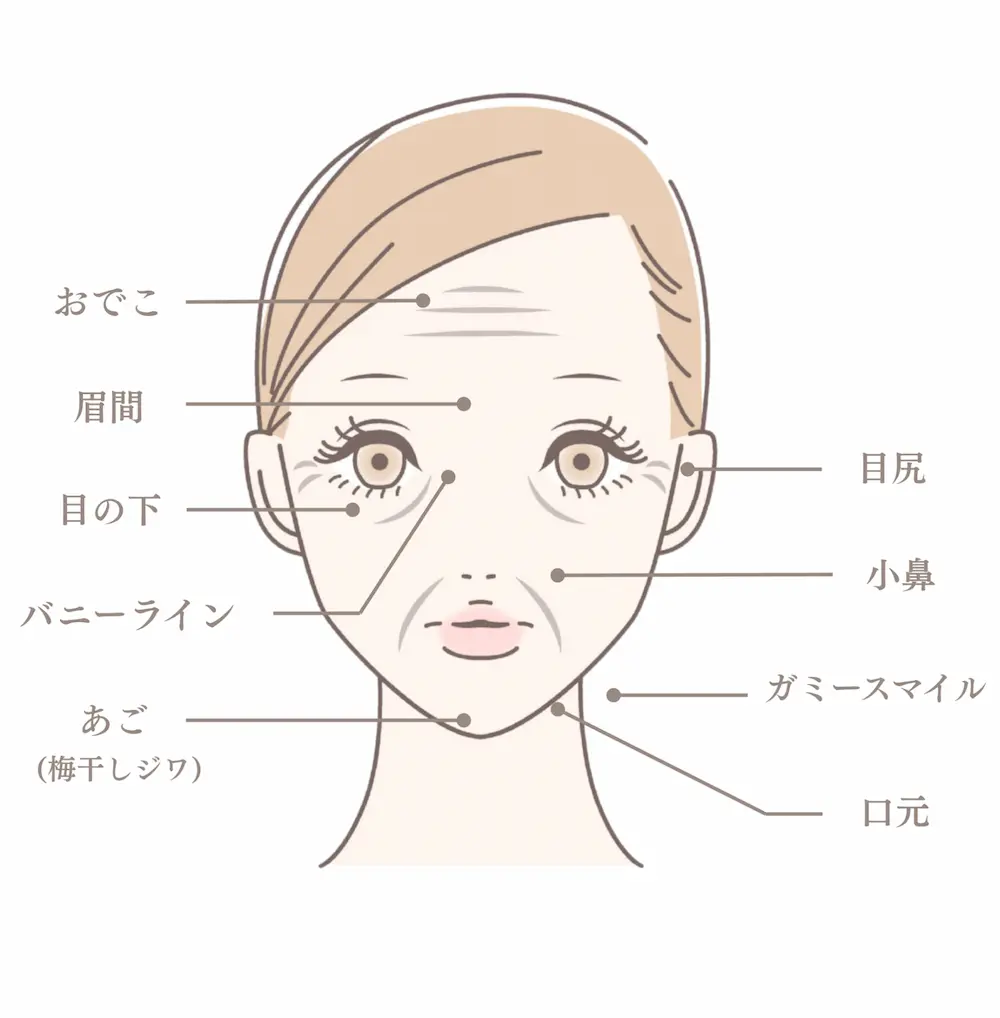 ボトックスが打てる部位