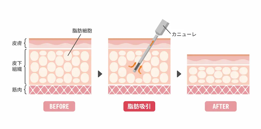 脂肪吸引による脂肪細胞の減少