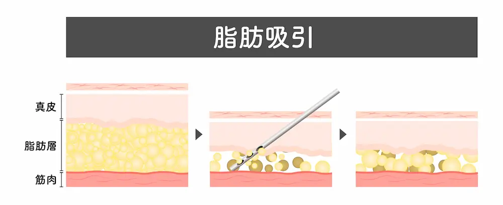 脂肪吸引による脂肪の減少