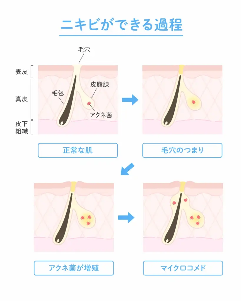 ニキビができる過程