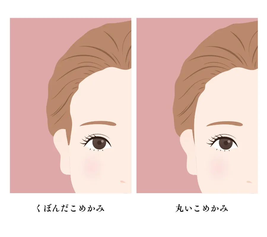 くぼんだこめかみと丸いこめかみ 比較