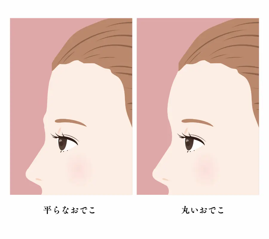 平らなおでこと丸いおでこ 比較