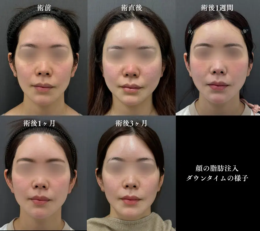 顔の脂肪注入|術前から術後3ヶ月までダウンタイムの様子