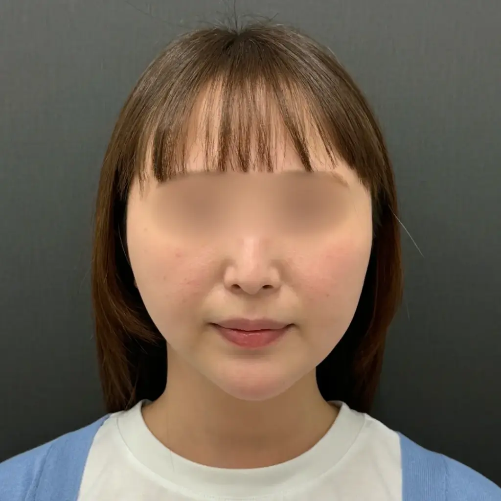 術後3ヶ月