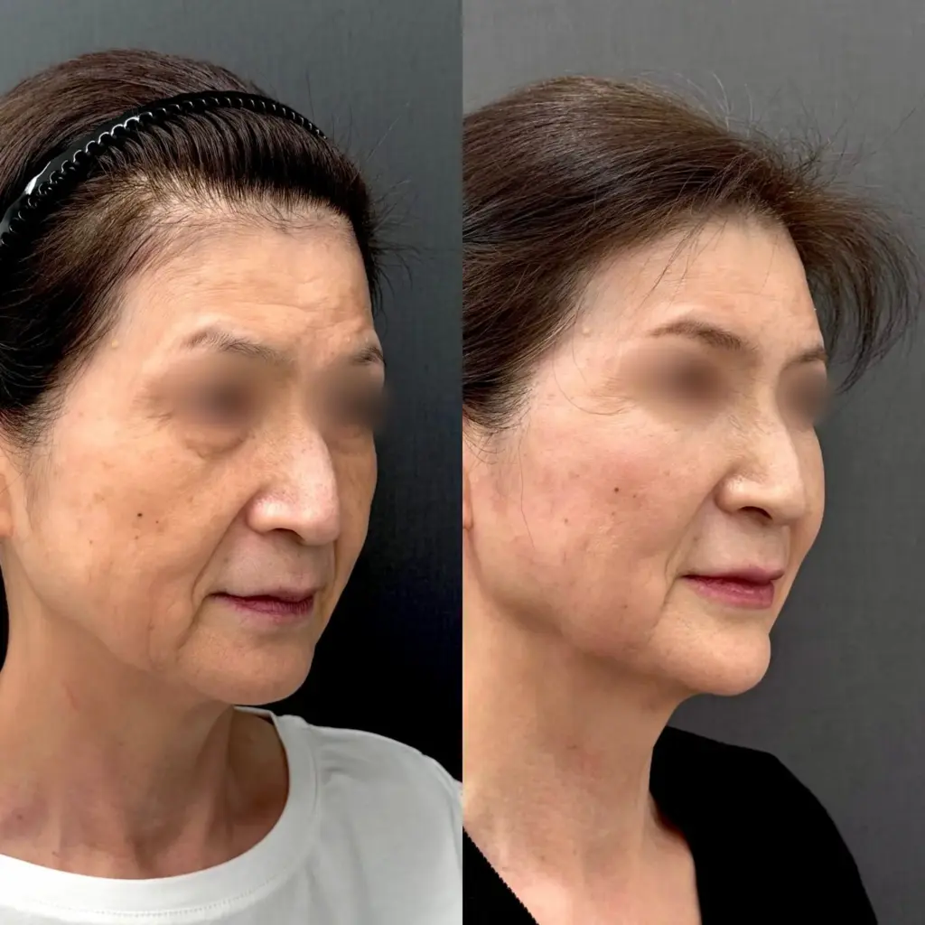 ヒアルロン酸リフト＋糸リフト＋シワ取りボトックスの症例 60代女性