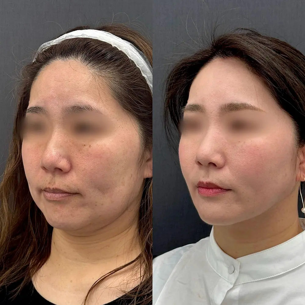 40代女性|アポロン式小顔脂肪吸引(6エリア) 糸リフト(ハイパーリフト10本)|術前・術後3ヶ月