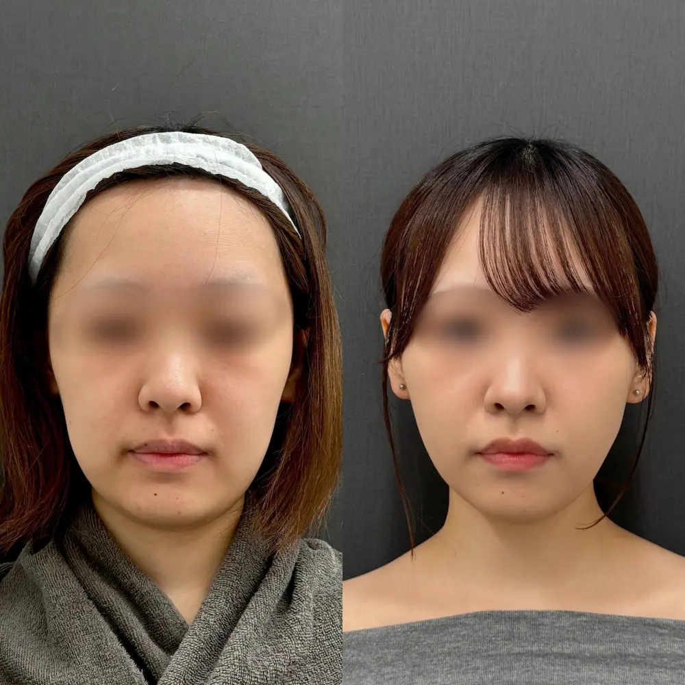 20代女性|アポロン式小顔脂肪吸引(5エリア) 糸リフト(アルテミスリフトスタンダード4本+アルテミスリフトプレミアム4本)|術前・術後3ヶ月