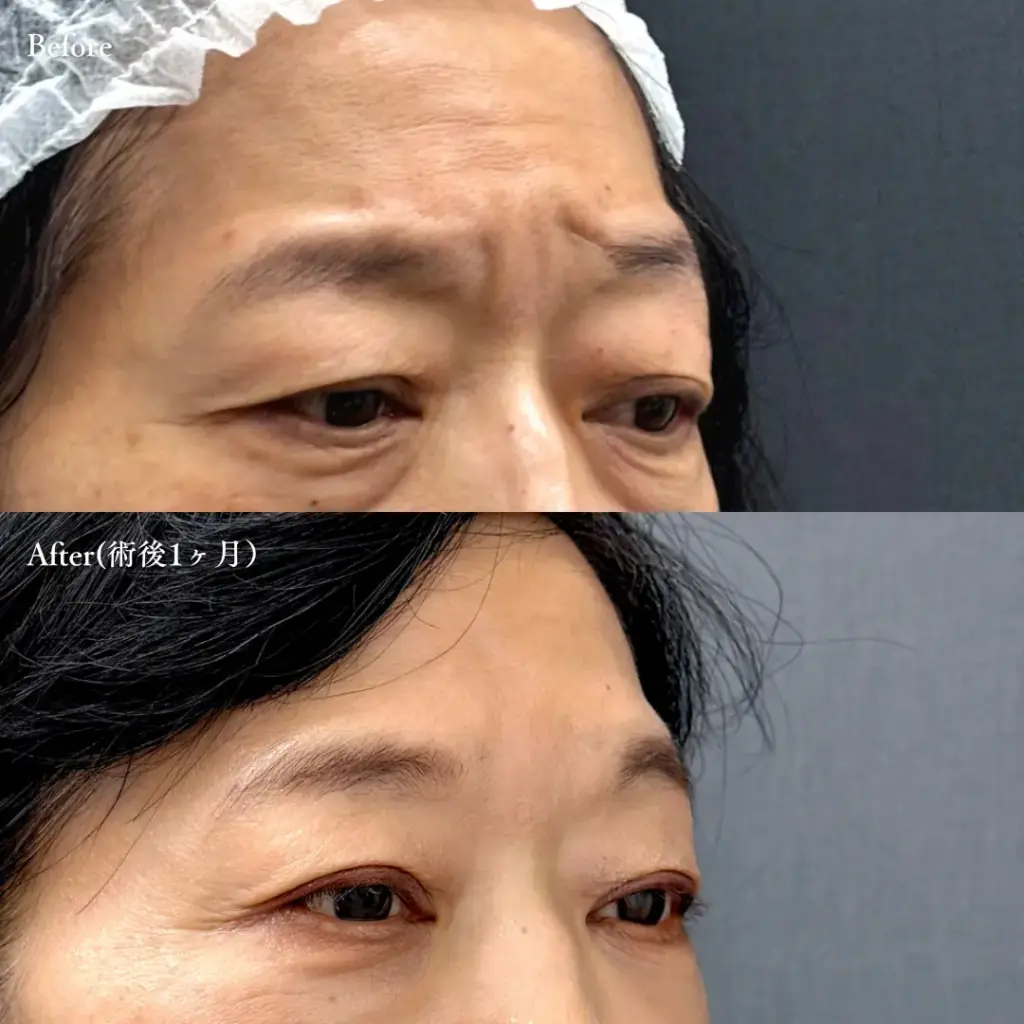 額・眉間のボトックス注射|術前・術後1ヶ月