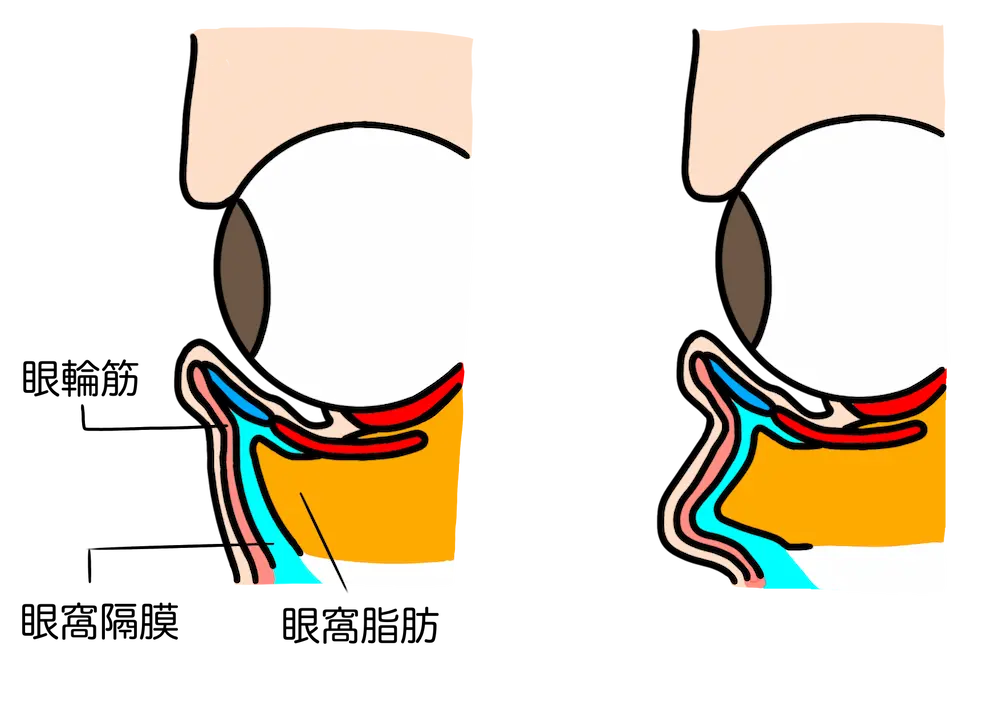 眼輪筋、眼窩隔膜、眼窩脂肪の説明イラスト