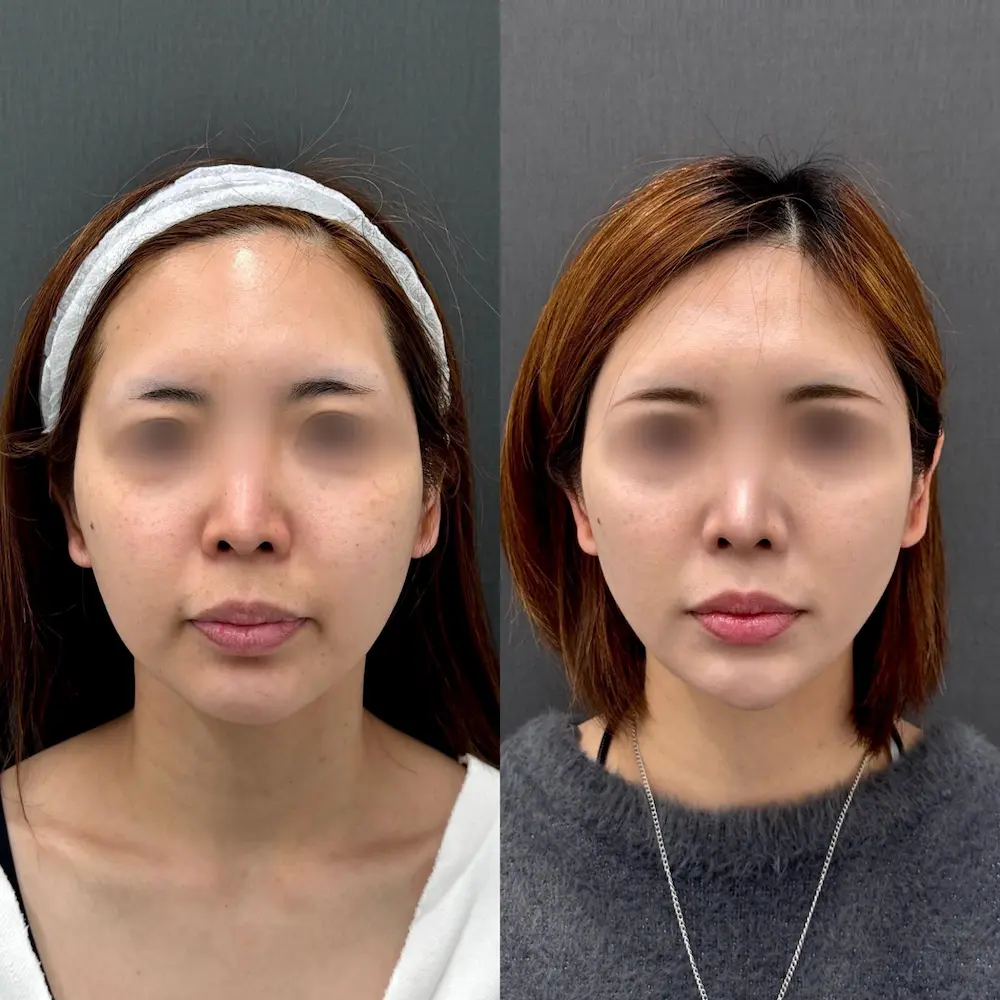 30代女性|ジョールファット除去 バッカルファット除去 糸リフト(アルテミススタンダード4本)|術後3ヶ月