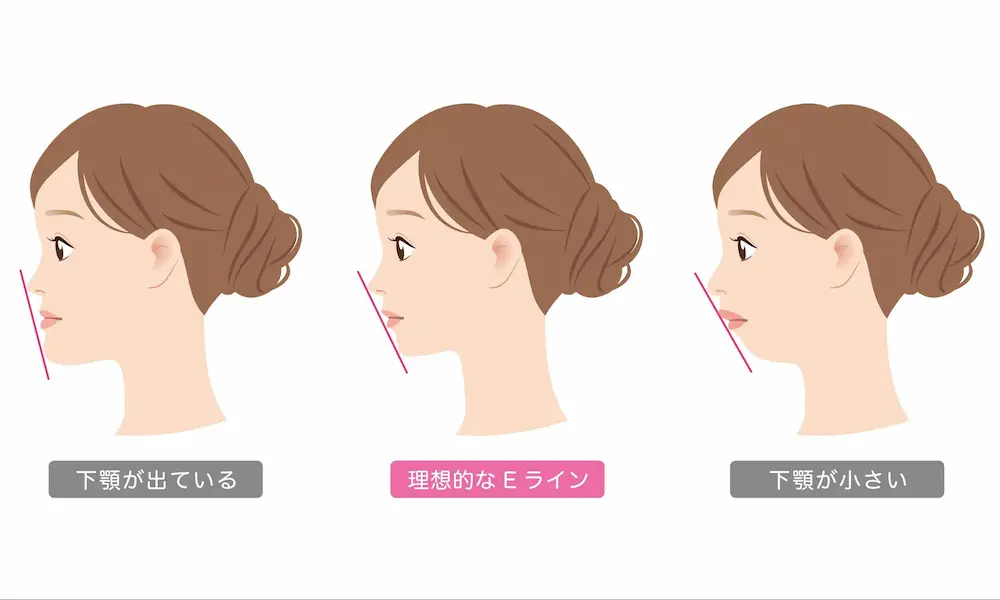 理想的なEラインと下顎が出ている・小さい場合の比較