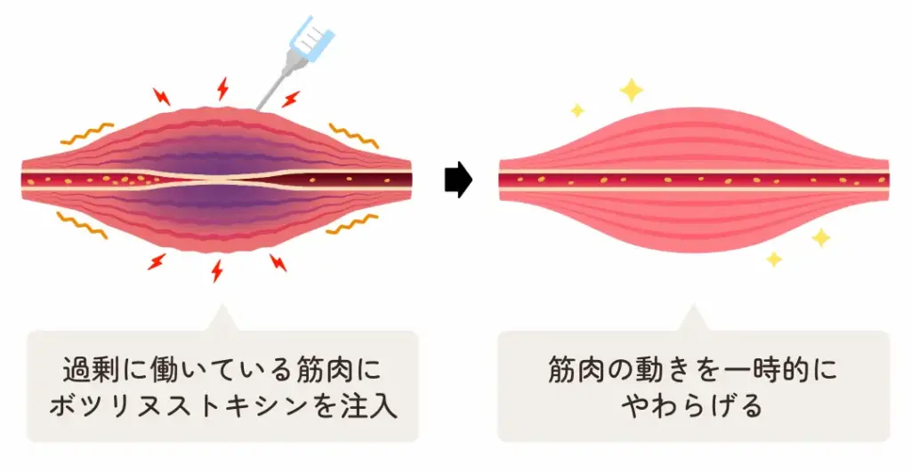 過剰に働いている筋肉にボツリヌストキシンを注入→筋肉の動きを一時的にやわらげる