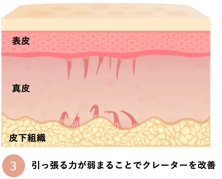 引っ張る力が弱まることでクレーターを改善