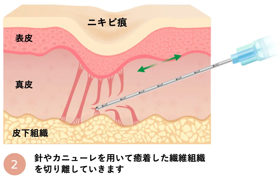 針やカニューレを用いて癒着した繊維組織を切り離していきます