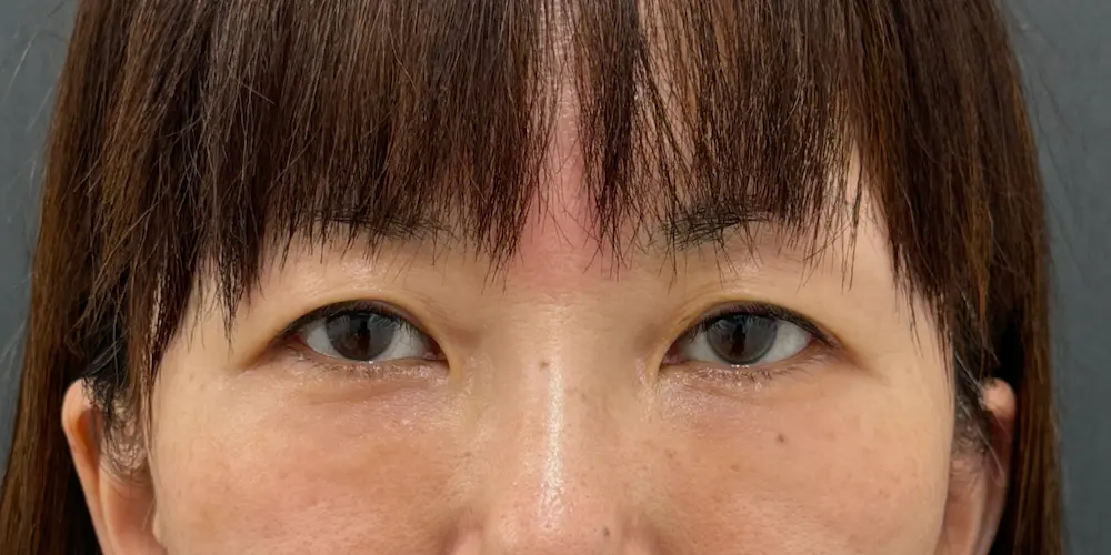 術後1ヶ月